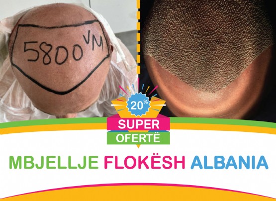 Mbjellje Flokesh Albania / Mbjellje Flokeve pa dhimbje / Mbjellja e flokeve DHI / Fue hair Transplant / TRANSPLANTI SAPPHIRE FUE Mbjellje flokeve sistemi i fundit / Implantimi i drejtperdrejte i flokeve / Metoda Fue Transplantimi i flokëve