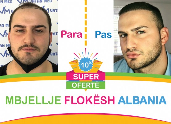 Mbjellje Flokesh Albania / Albania Hair / hair transplant / Hair Transplant Albania / hair transplantation / hair transplantation Tirana Advanced FUE hair Clinic / FUE Hair Transplant Method Albania / Fue method Hair transplant Albania